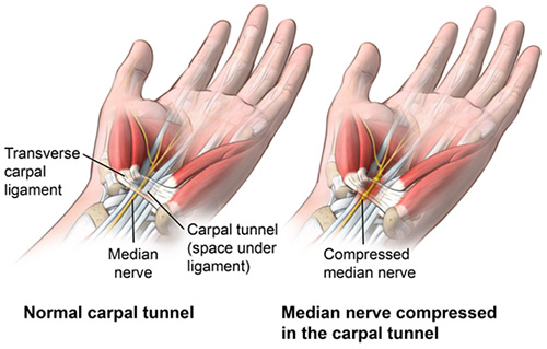 Carpal tunnel locations