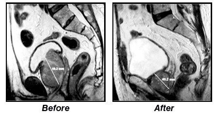 prostate artery embolization before and after