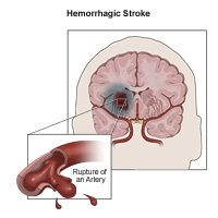 Hemorrhagic Stroke