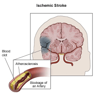 Ischemic Stroke