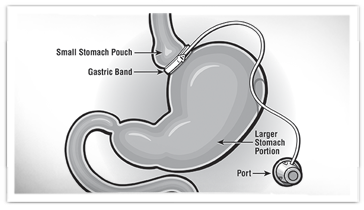 Laparoscopic gastric banding