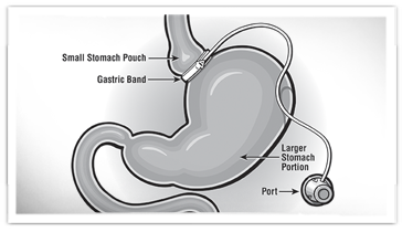 Laparoscopic gastric banding image