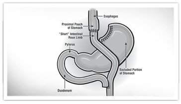Gastric bypass surgery (Roux-en-Y) image