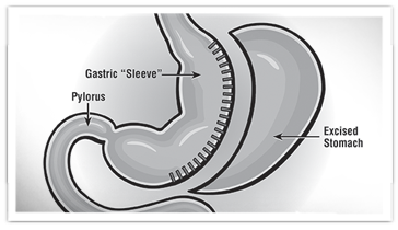 Sleeve gastrectomy