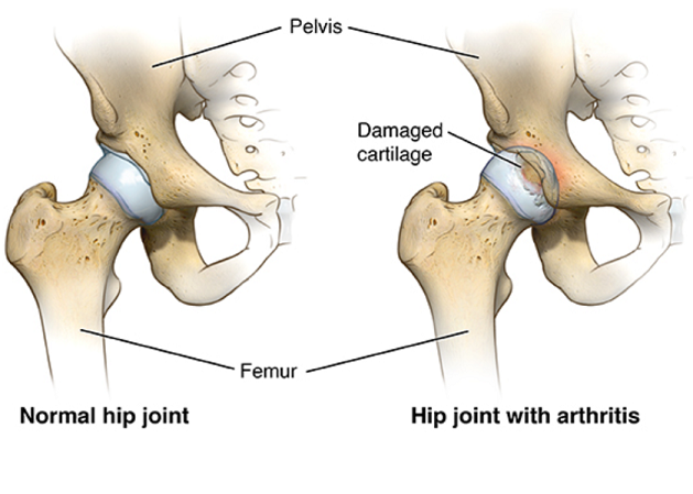 Osteoarthritis