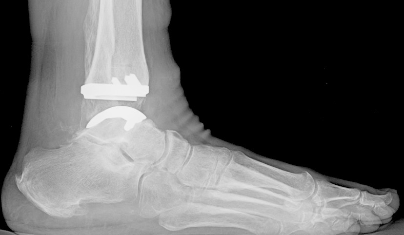 xray image showing total ankle arthroscopy