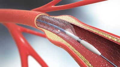 3d illustration of stent implantation