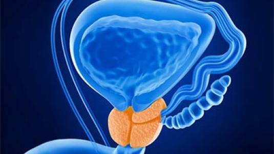 prostate cancer image