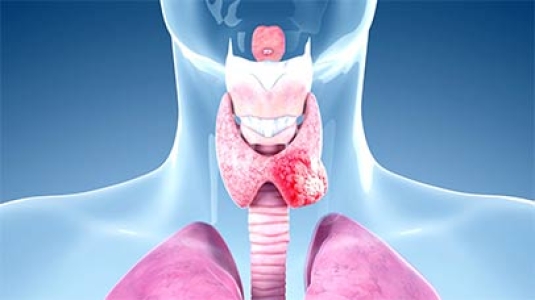 thyroid cancer image